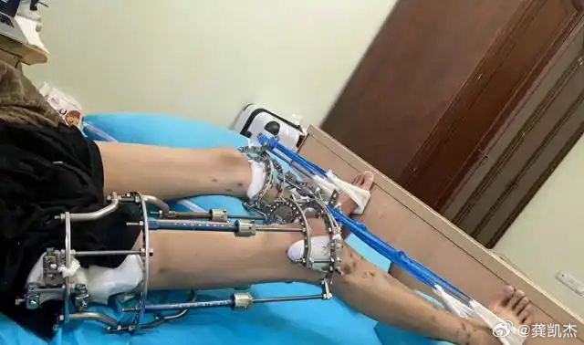 断骨恢复过程断骨恢复过程全解析，一步步见证重生之旅