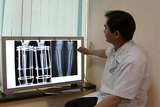 4次断骨打开折叠男孩迈出新生第一步折叠人生，勇敢迈步，一个男孩的重生之旅